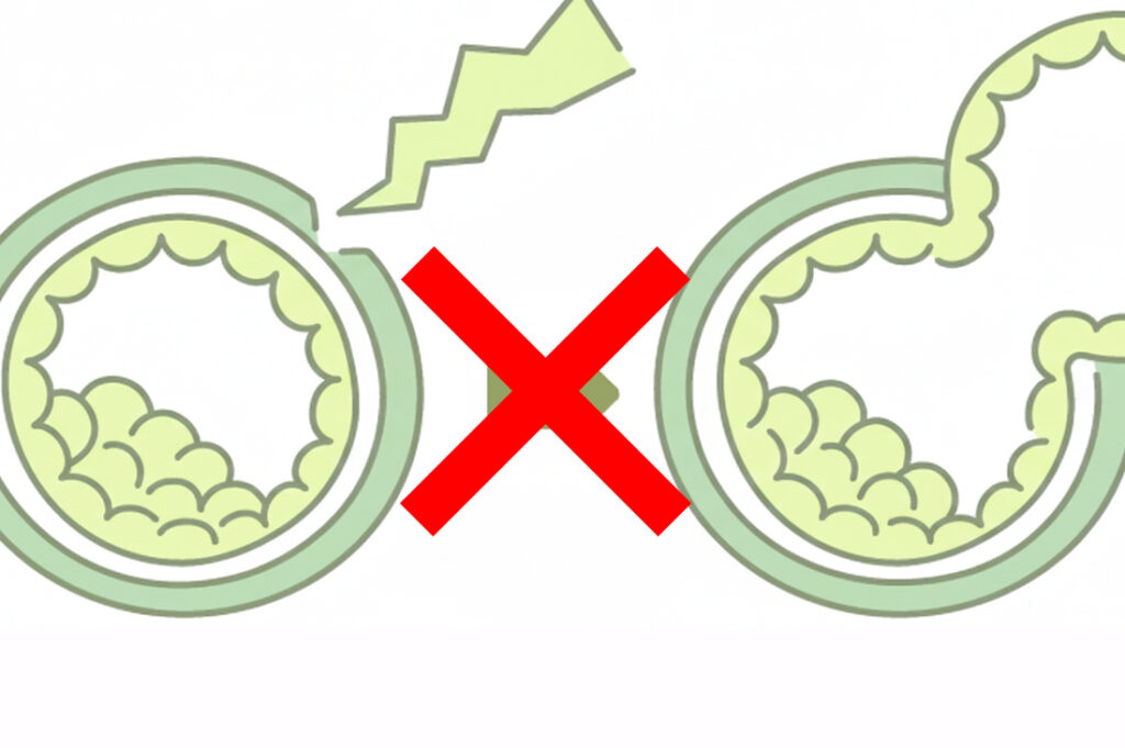 アシストハッチング　意味ない